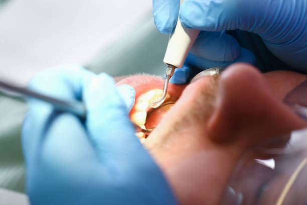 Best Knocked-Out Tooth (Avulsed Tooth) Treatment in Hattiesburg, MS